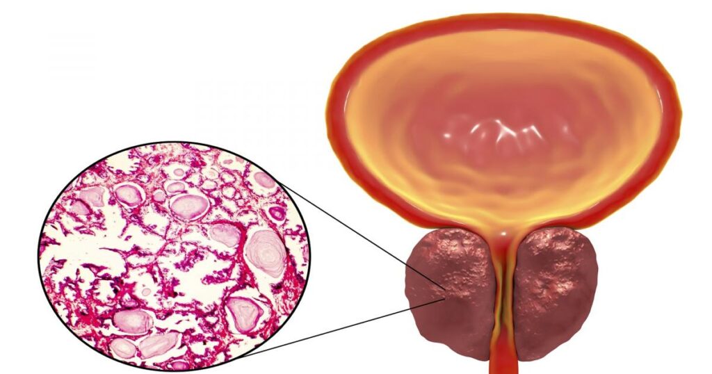 عقار جديد يفتح آمالاً في علاج التهابات البروستات المزمنة