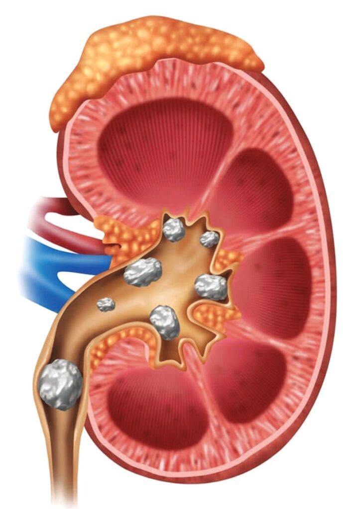 حصوات الكلية .. كيف نمنع تكرار الإصابة بها ؟