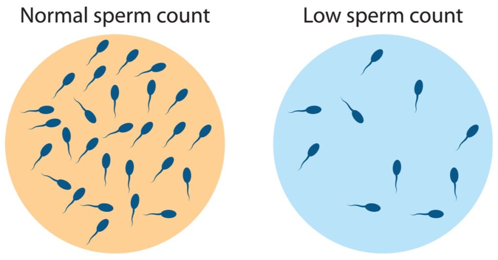 نقص شديد في عدد الحيوانات المنوية