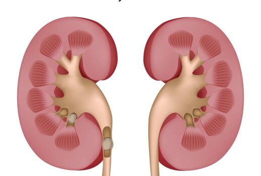 حصوات الكلى.. الطرق الوقائية لمنع تكرار الإصابة بها..!
