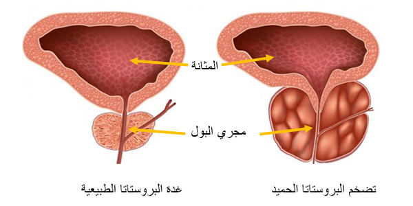 البروستات الحميد