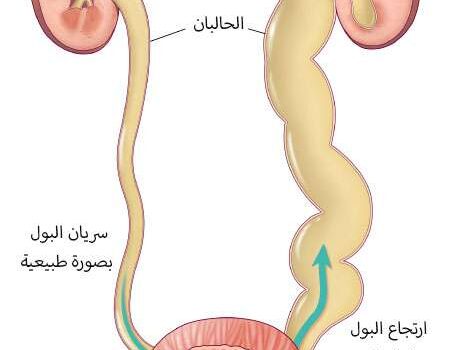 ارتجاع البول في الكليتين