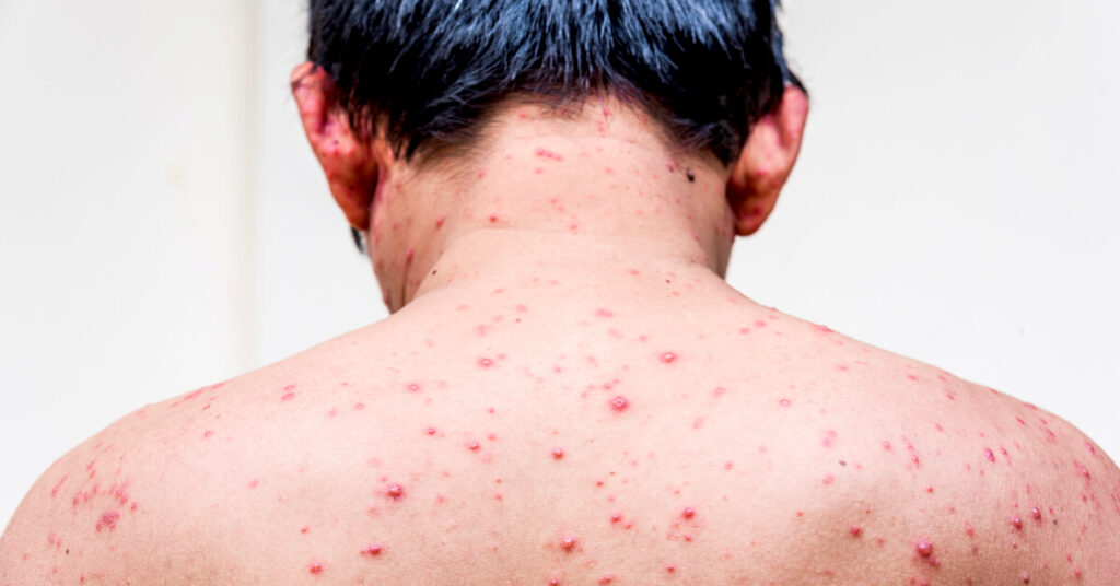 مرض الايدز وما هي أعراضه؟