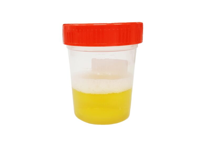 الزلال البولي.. قد يكون أول علامات الفشل الكلوي!