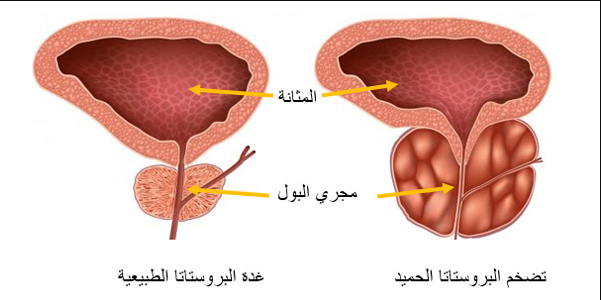 الفرق بين تضخم البروستات الحميد وسرطان البروستات