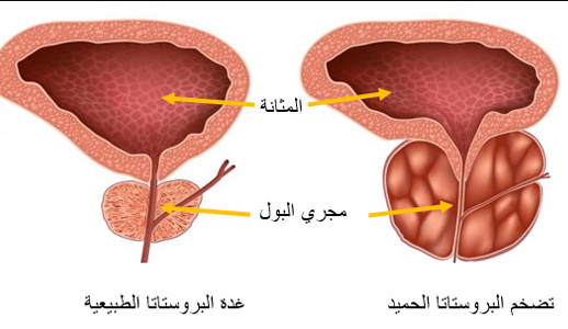 الفرق بين تضخم البروستات الحميد وسرطان البروستات
